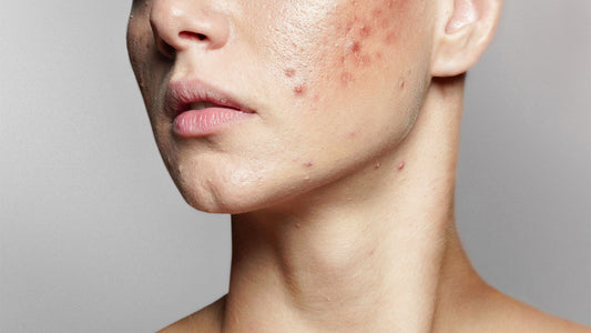 5 Helpful Hints for Breaking Up with Blemishes